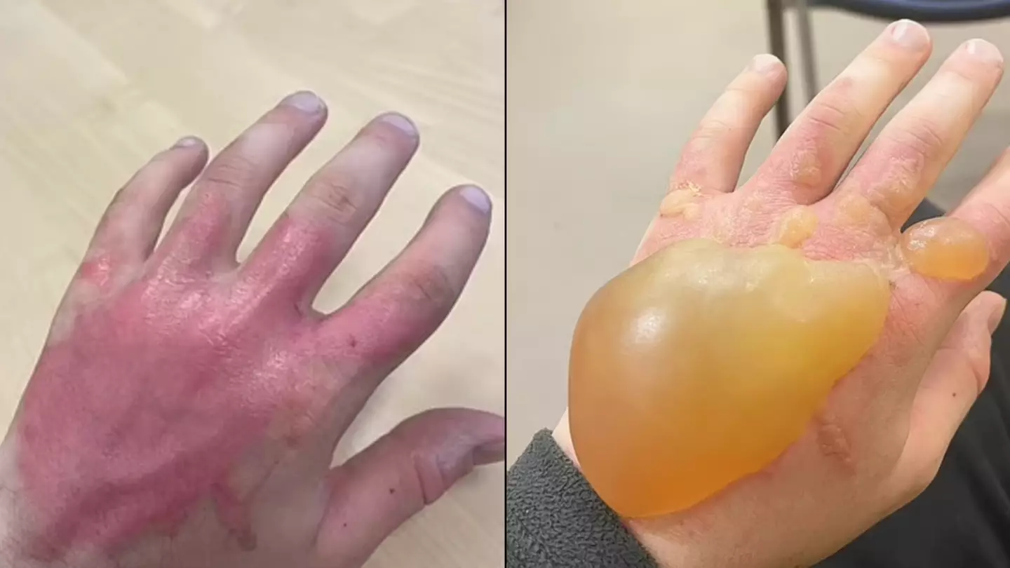 Britain's most dangerous plant leaves teen with huge blister 'size of an orange'