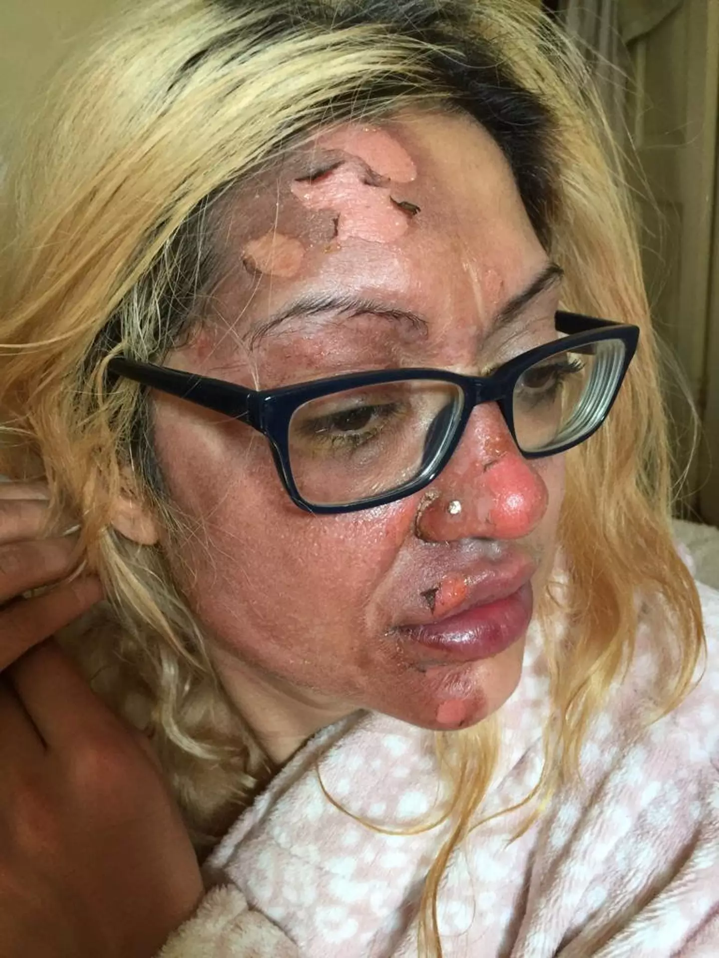 A mum who tried a TikTok trend was left in 'absolute agony' after an egg exploded in her face.