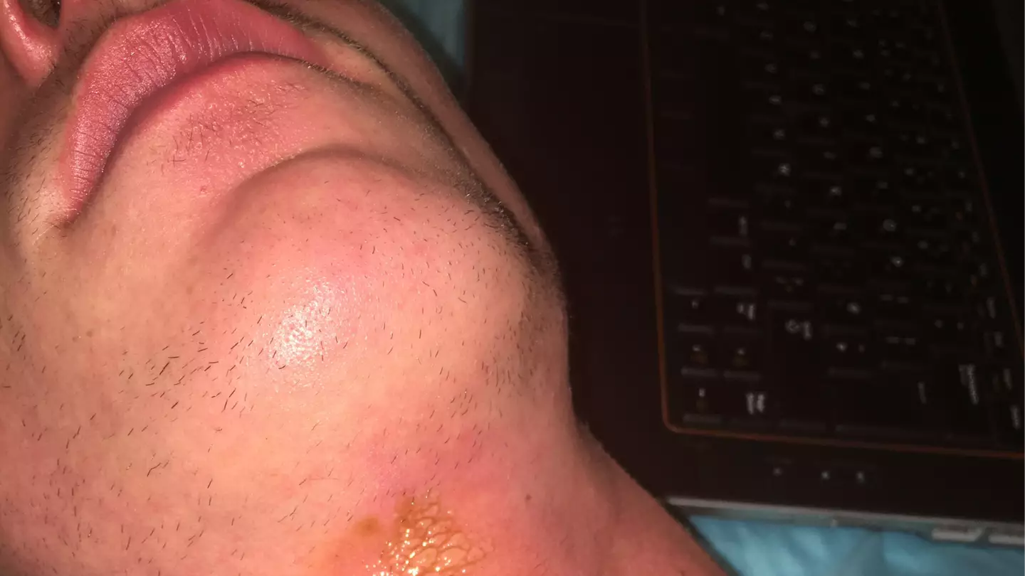 Brit issues major warning after suffering second-degree burns when jewellery turned into ‘laser beam’