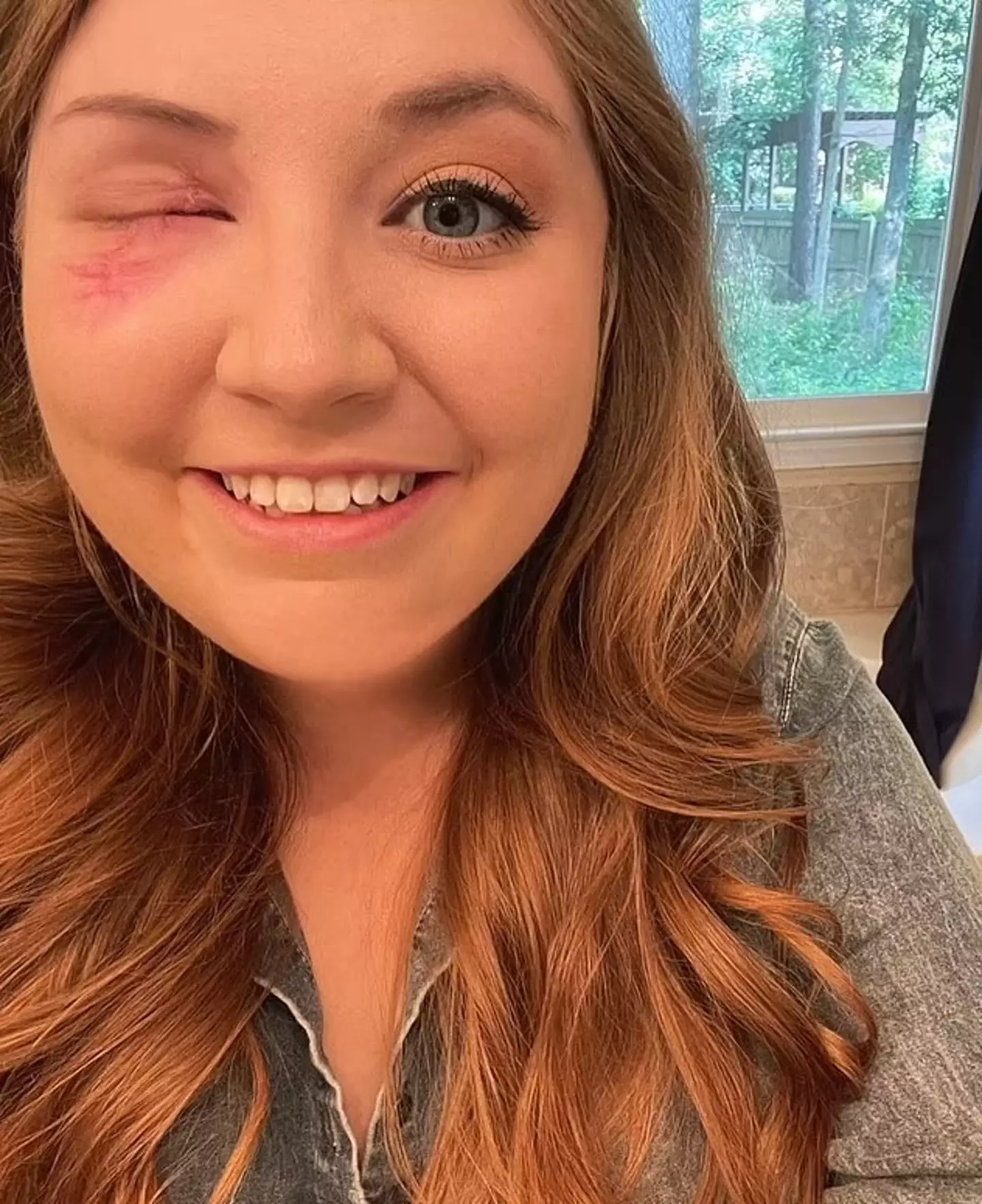 Hannah lost her eye following the 'minor' car crash.