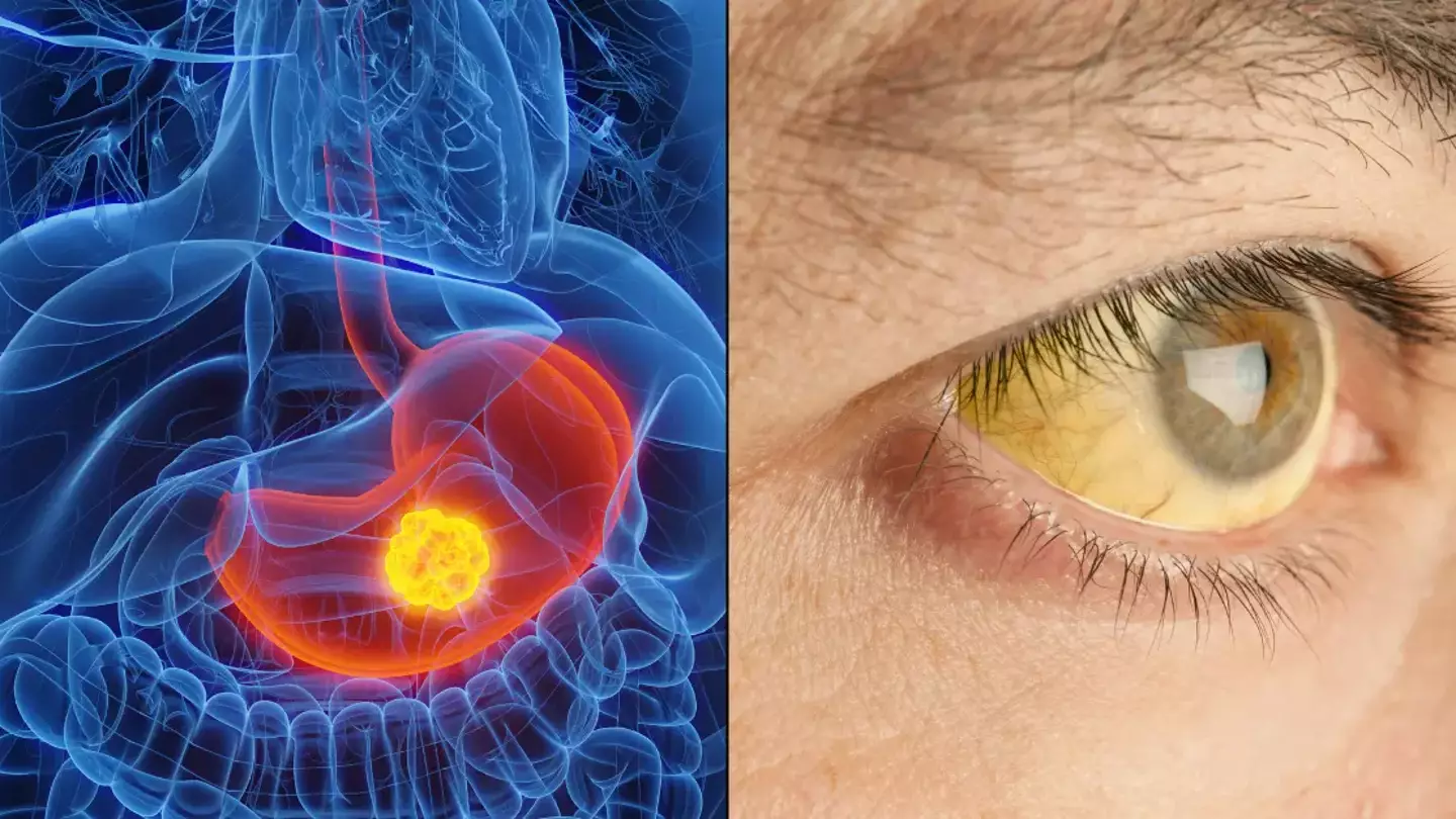 Alarming reason little-known form of cancer is surging in cases with people under-30