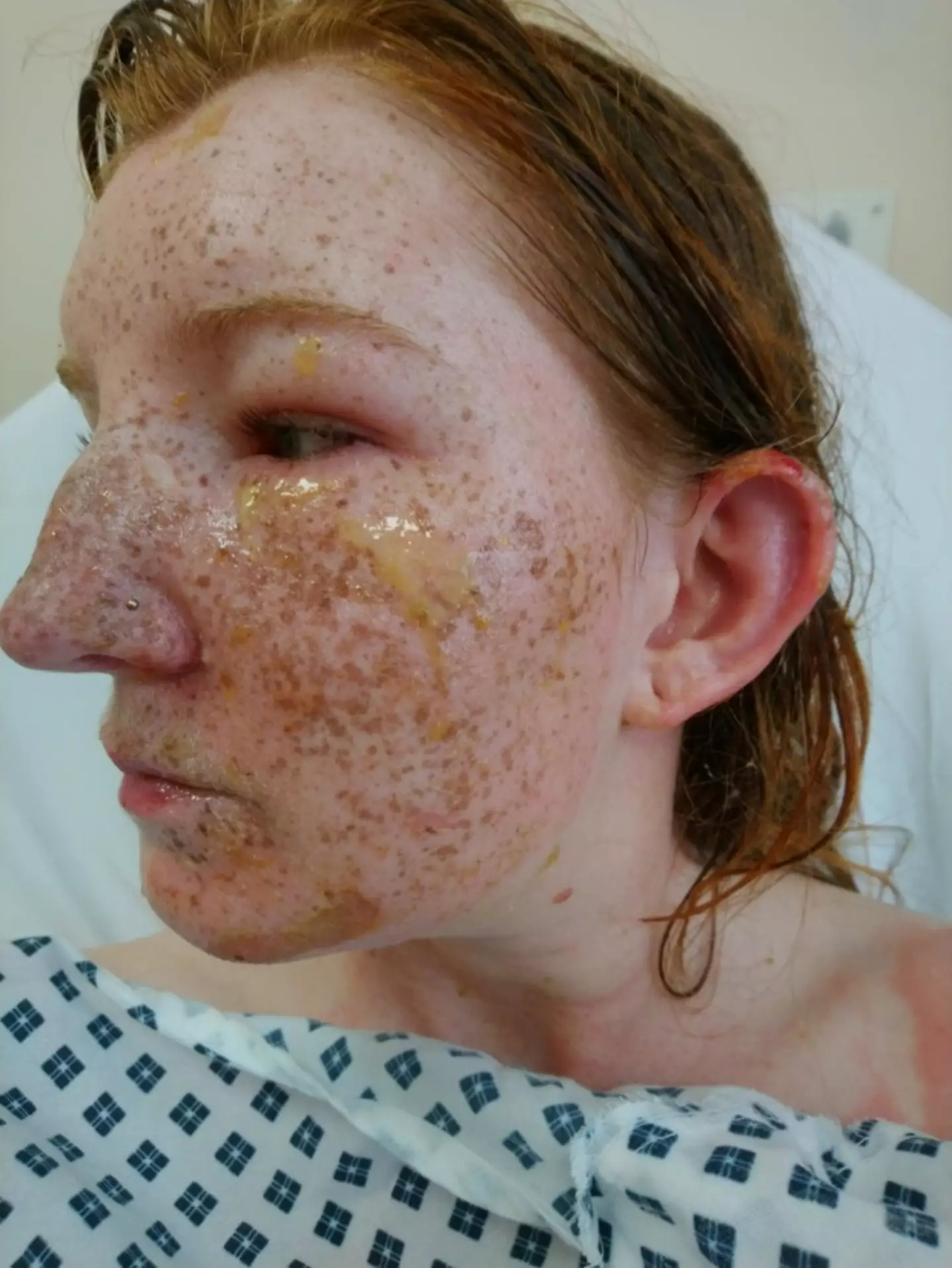 Her freckles gradually 'died' and fell off.