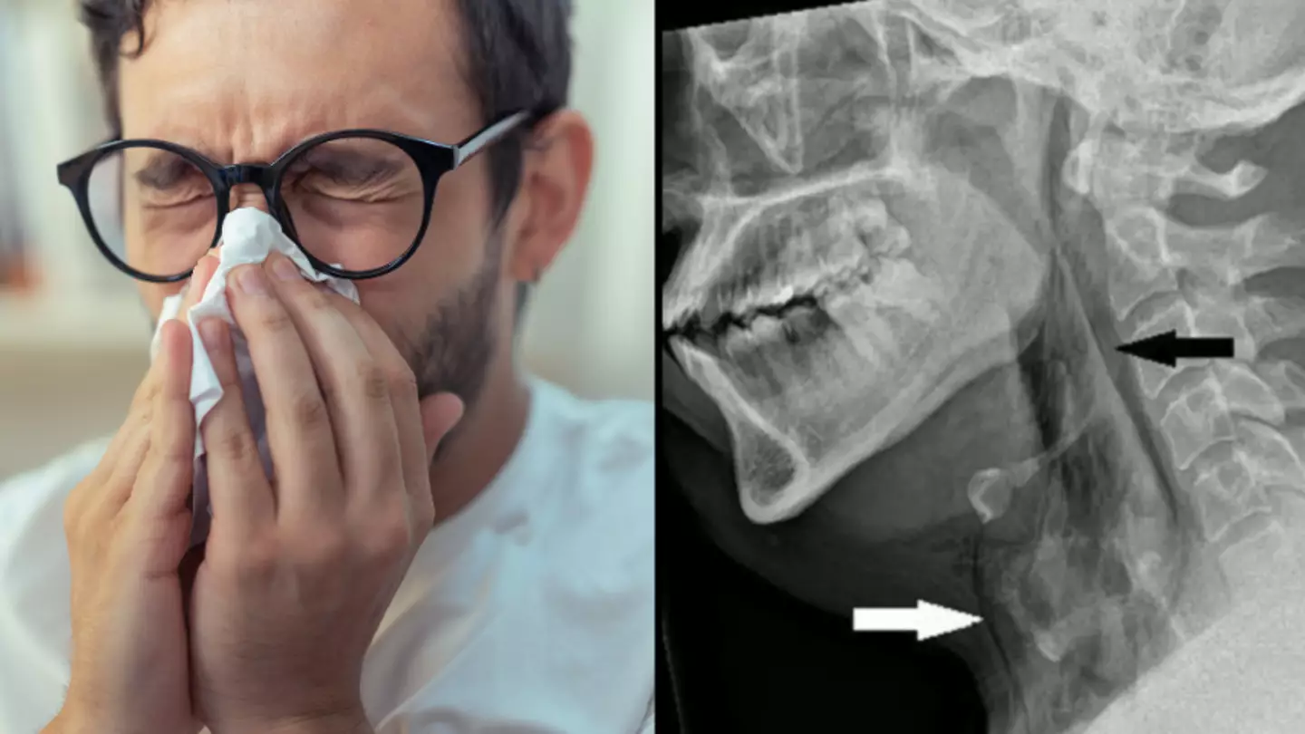 Doctors issue warning over holding in a sneeze after man tears hole in throat