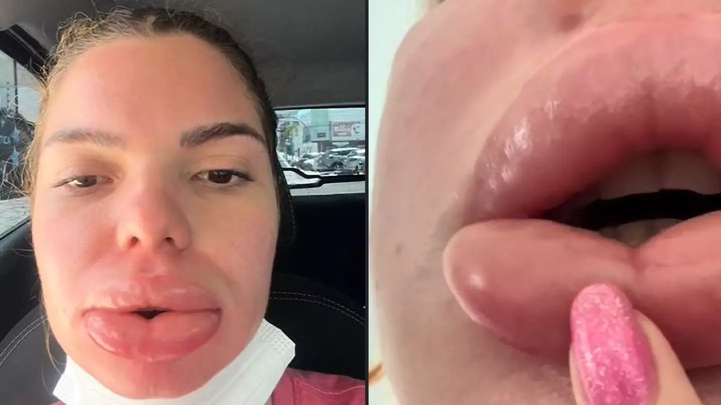 Woman in agony as blood supply to mouth is cut off after ‘routine’ lip filler operation