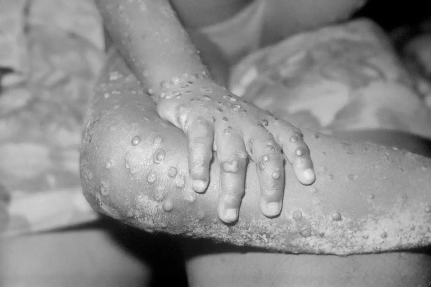 Rising monkeypox cases have been linked to sexual transmission at festivals.