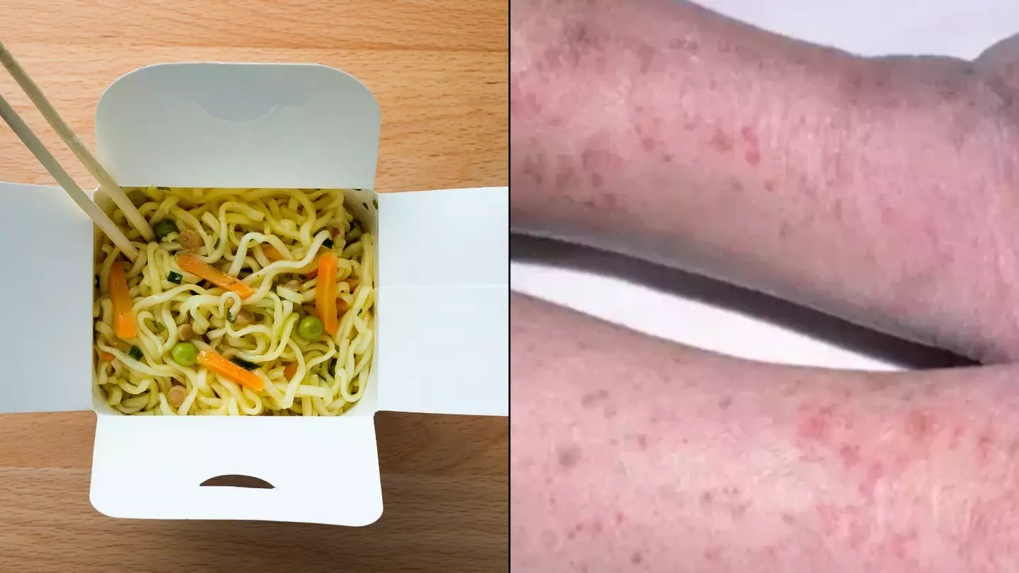 Student lost all his limbs after eating his roommate’s leftover noodles for lunch