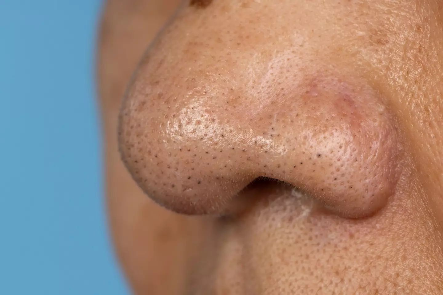 Blackheads are simply a type of acne. (Getty Stock Image)