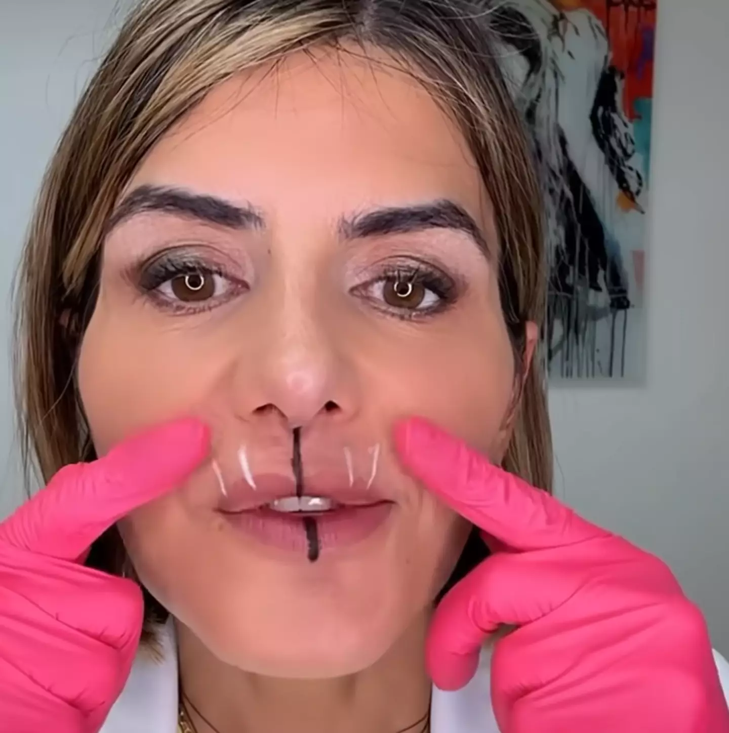 The doctor began by explaining how using botox for a lip flip works (Youtube/DrBitaFarrell)