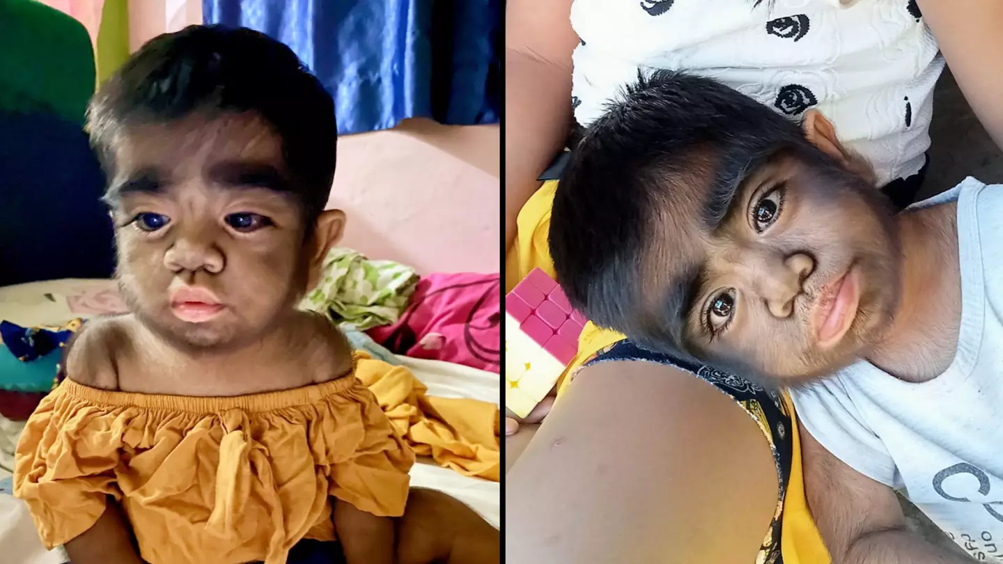 Mum fears son's 'werewolf syndrome' was caused by her eating cat during pregnancy