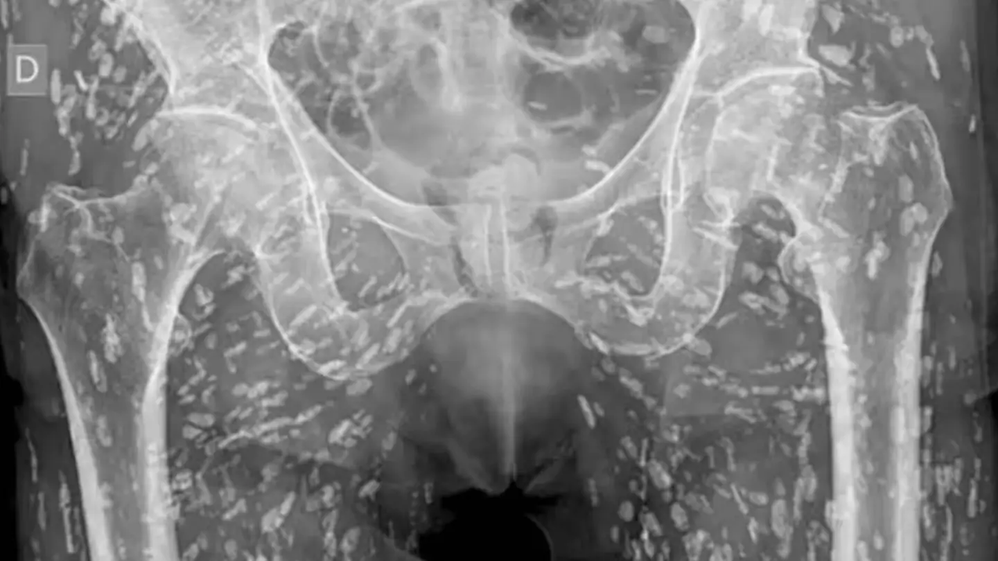 Disturbing X-ray shows body infested with tapeworms after major kitchen mistake