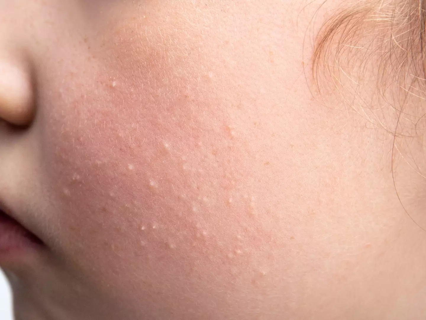 Milia can affect people of any age, experts say (Getty Stock Image)