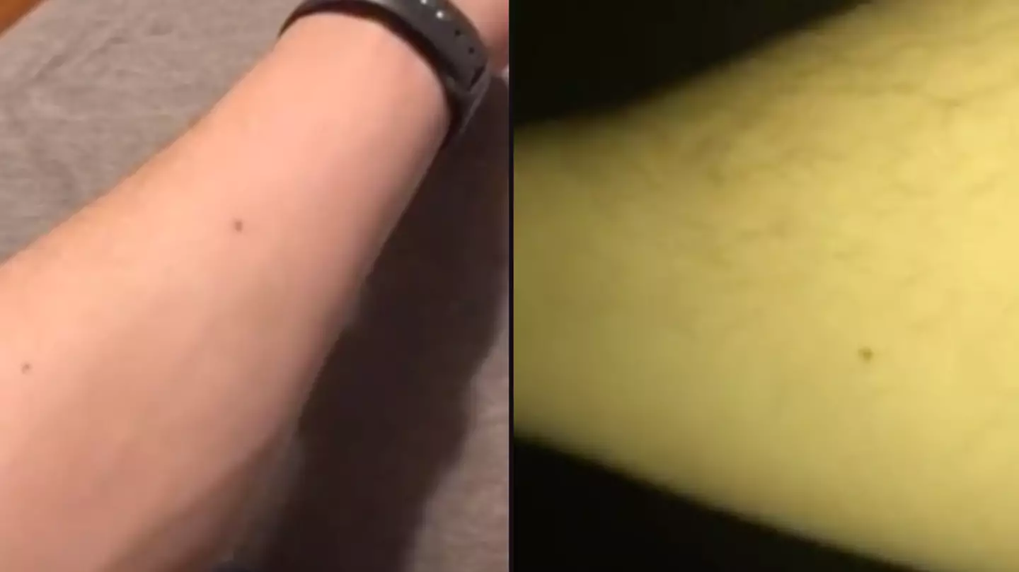 Man claims to have found freckle on body that all blokes have