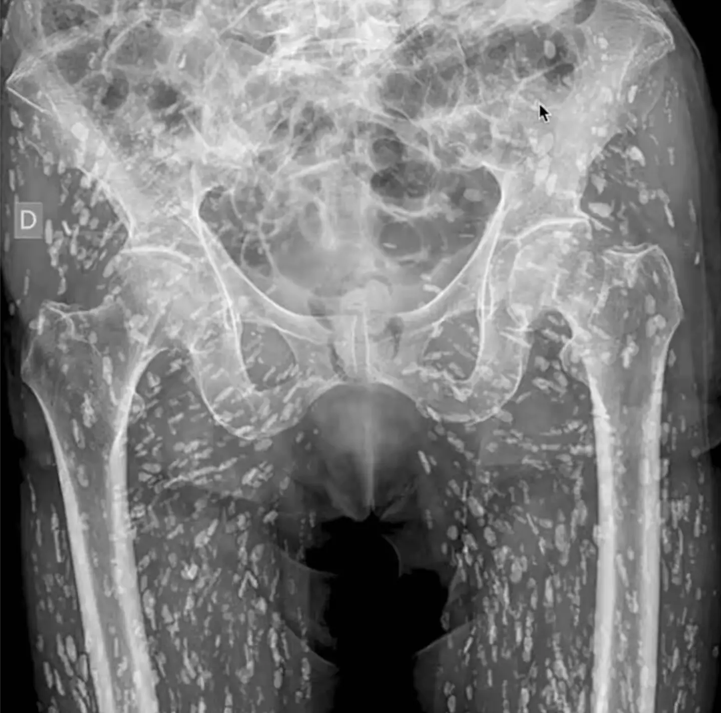 The disturbing X-ray has been shared on social media (X/@EM_RESUS)