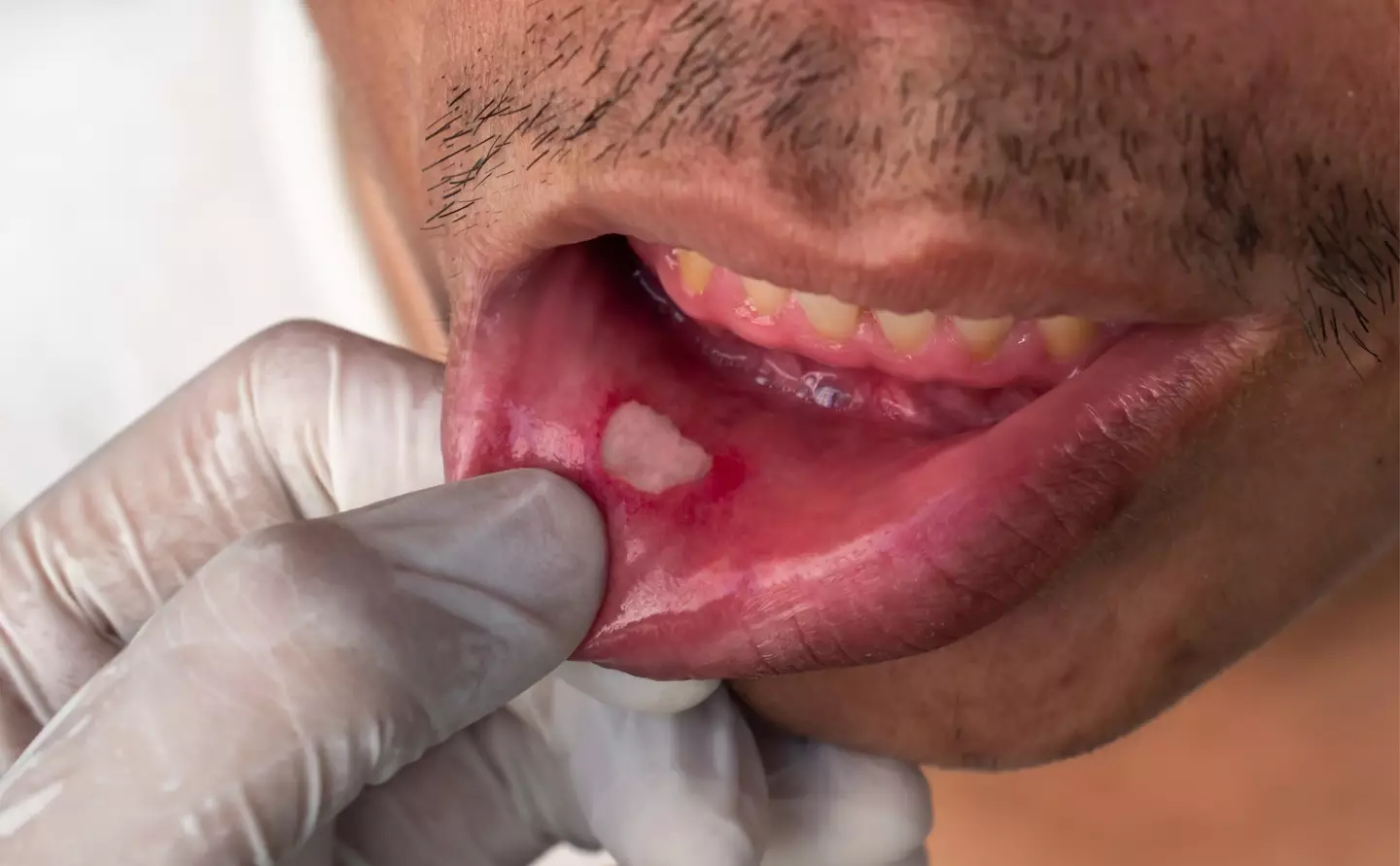 Mouth ulcers can be pretty painful (Getty Stock Photo)