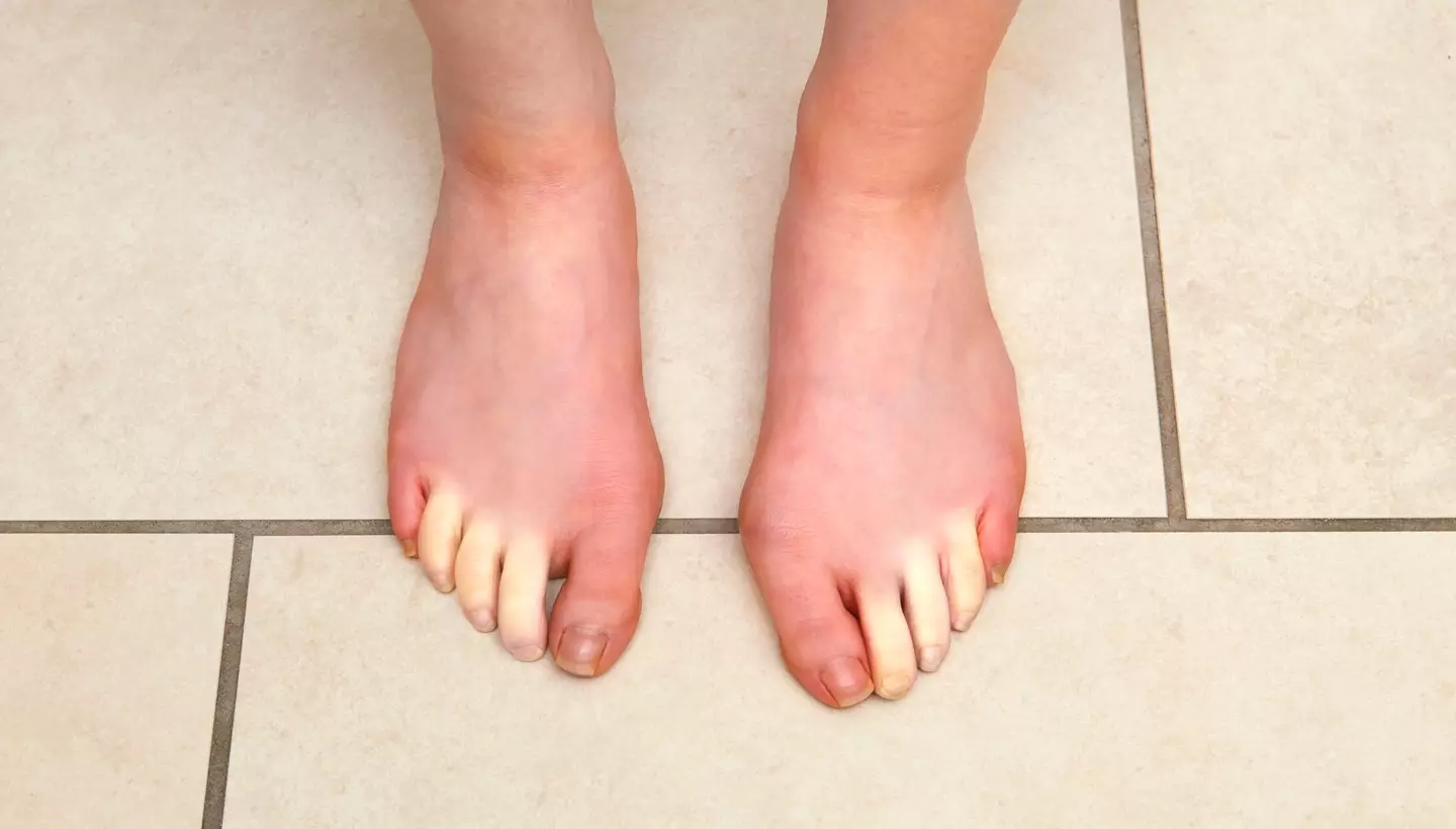 Raynaud's disease impacts your feet as well as hands (Getty Stock Images)