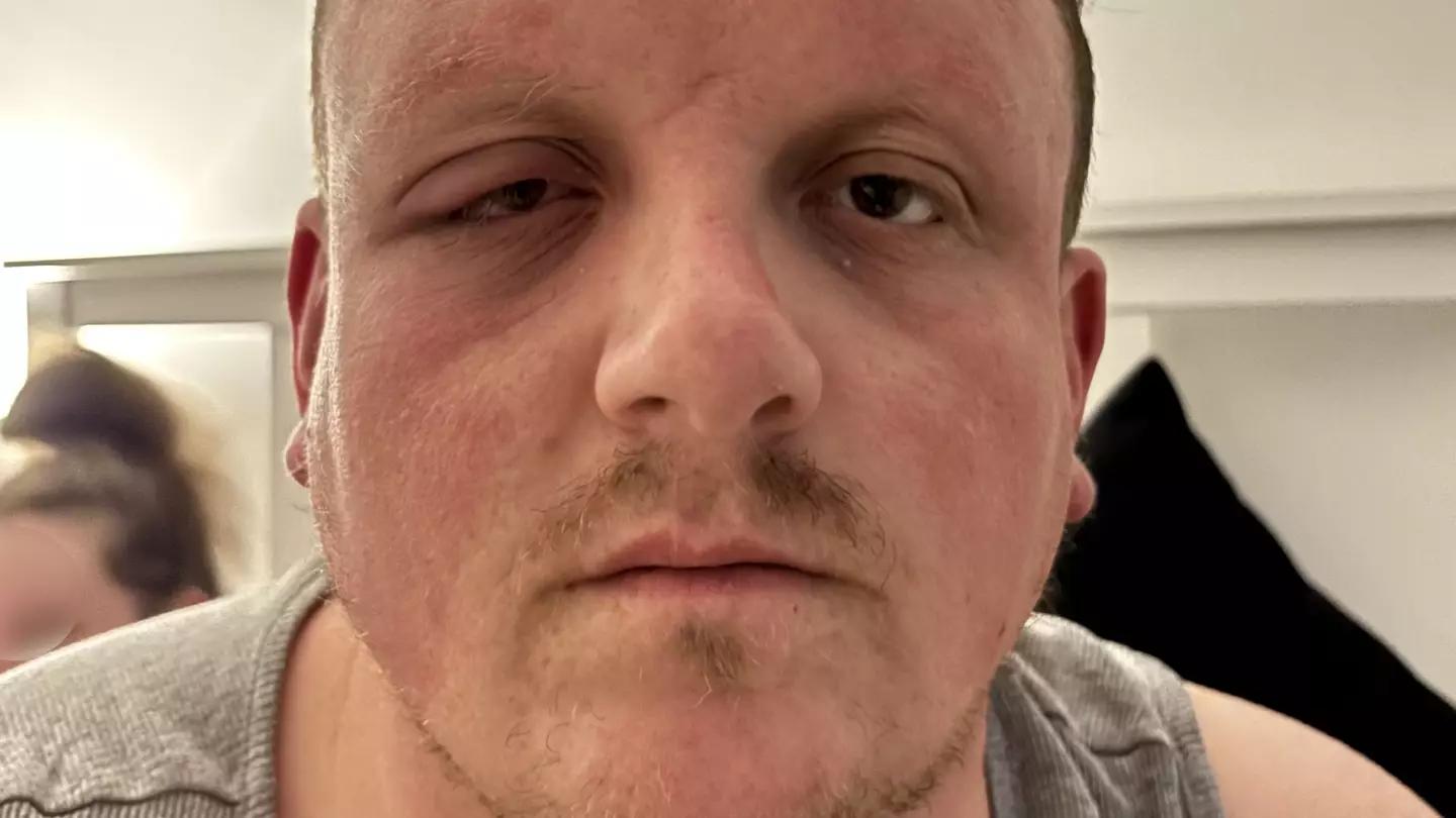 Dad who ignored 'pink eye' could have died after infection left him looking like 'Sloth from The Goonies'