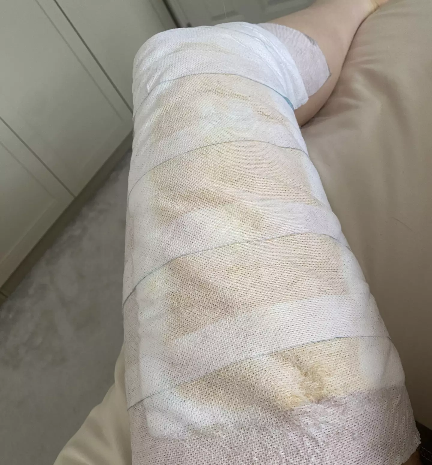 The 27-year-old said '25% of her lower body had been burnt' (Kennedy News and Media)