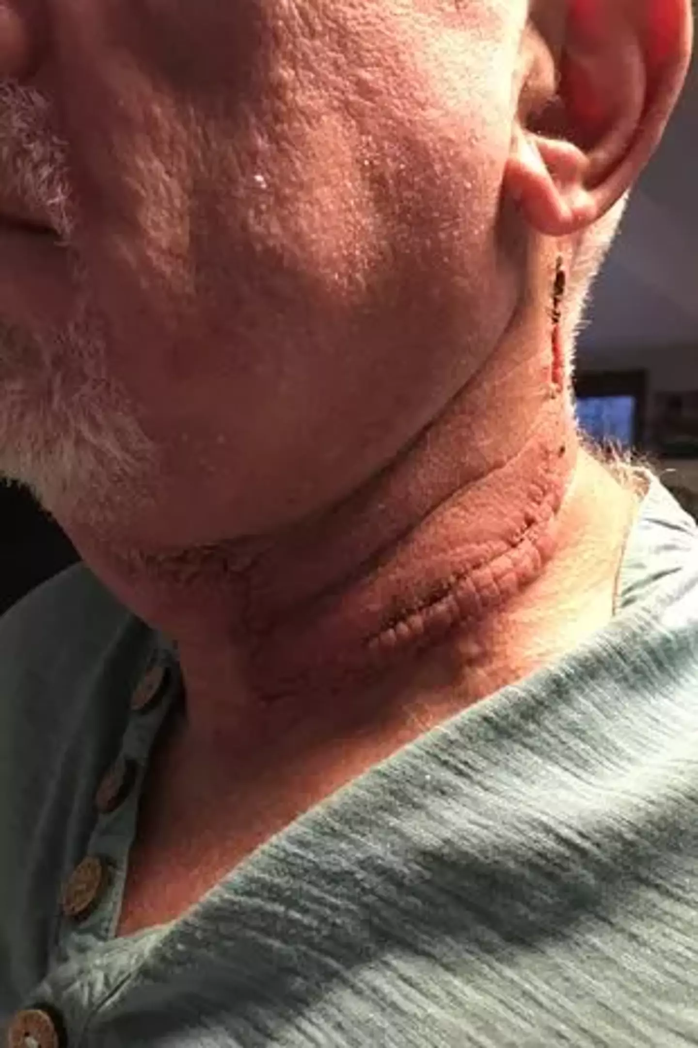 The cancer survivor underwent a gruelling 10-hour operation following his diagnosis (Chris Byrne)