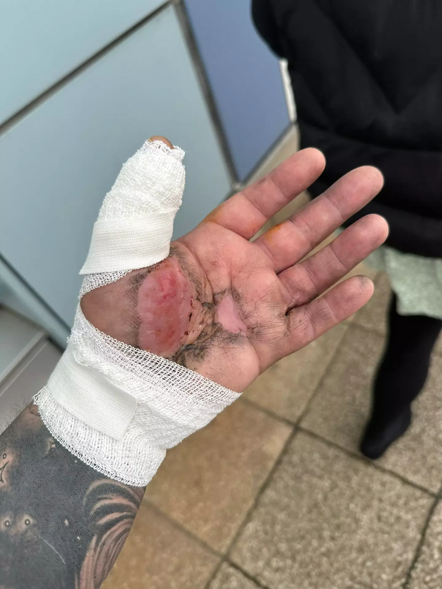 The lorry driver suffered horrible injuries including horrendous burns to his hand.