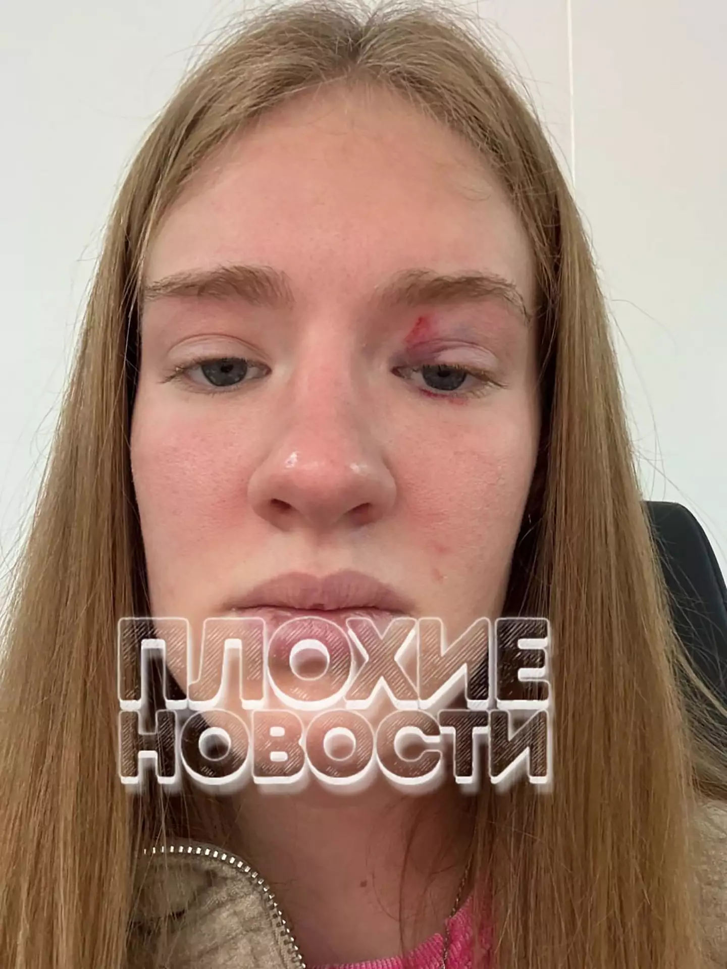 The mermaid performer opened up about her injuries (East2West News)