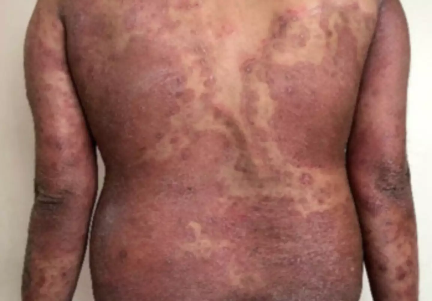 The fungus spreads fairly easily, as experts expect numbers to rise (MDPI)