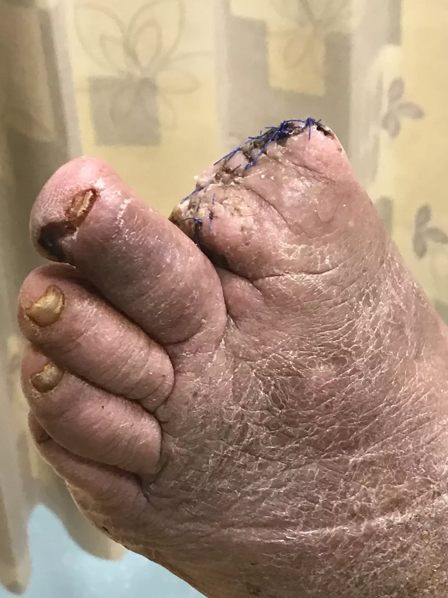 Doctors were amputating his toes but the pain wasn't going away (Kennedy News and Media)