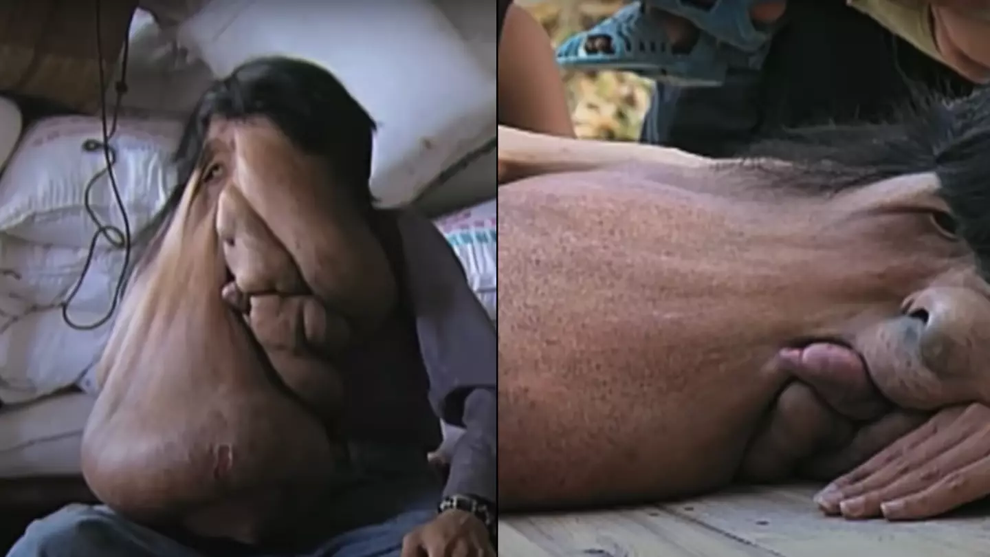 Heartbreaking reason why 'Elephant Man' with biggest ever facial tumour had to leave school
