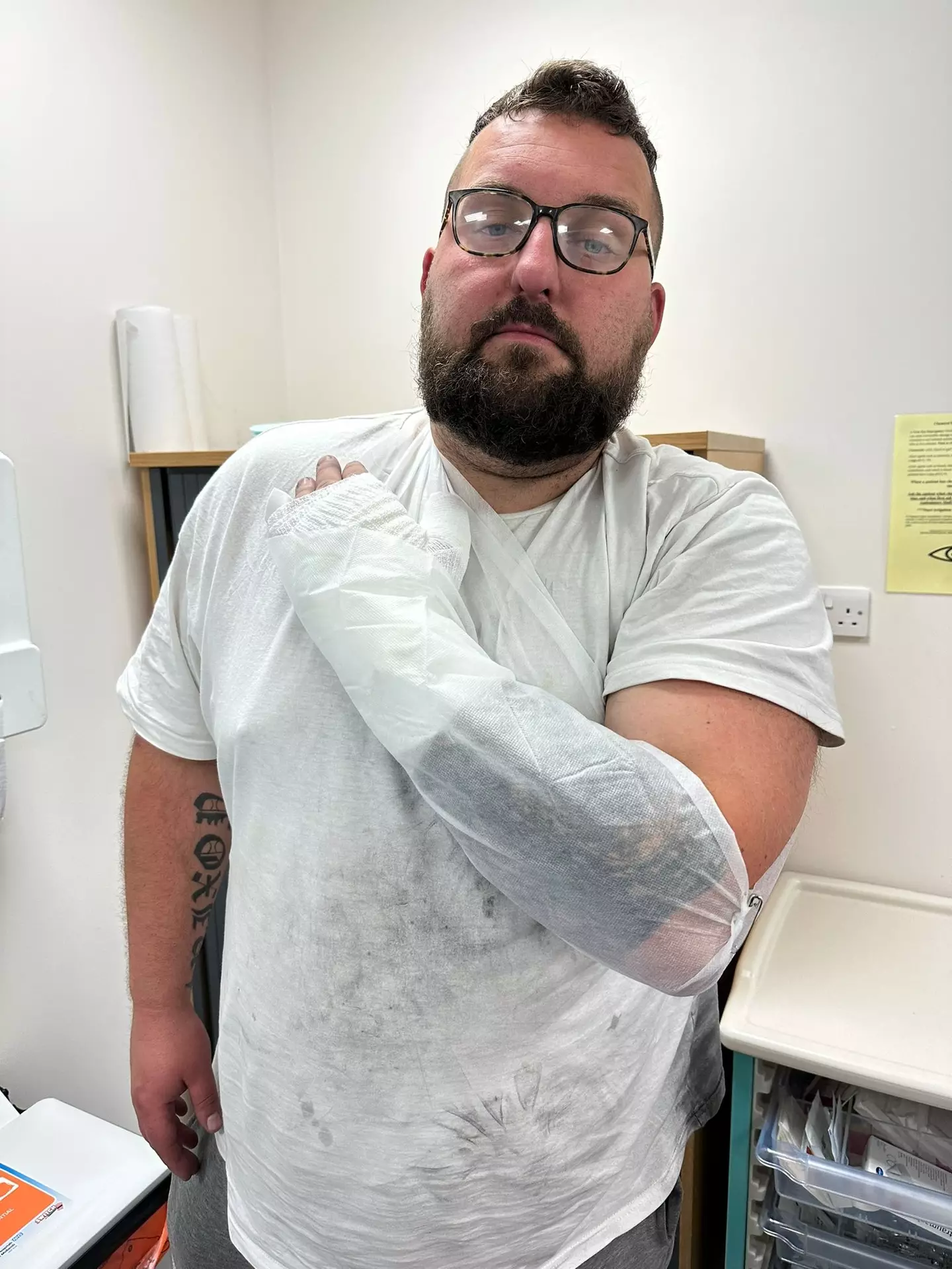 Mike Calver was changing the battery in his e-cigarette when it exploded in his hand.