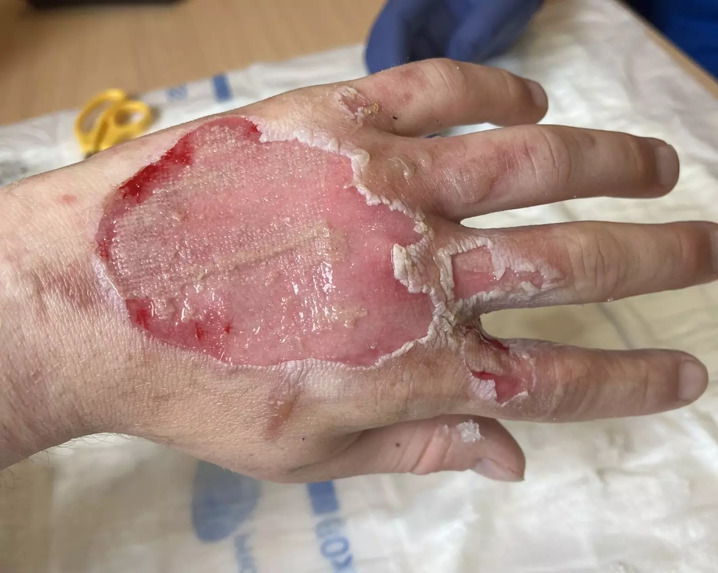 The aftermath was extremely painful for the teen. (Pen News)