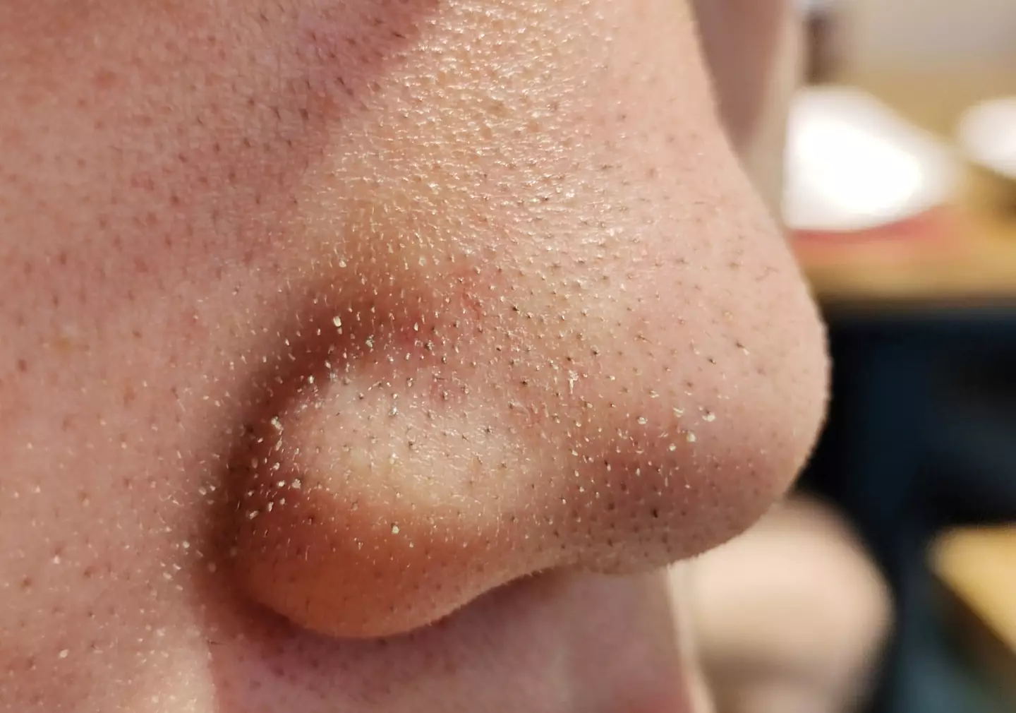 These black dots on your nose aren't blackheads at all (Getty Stock Images)