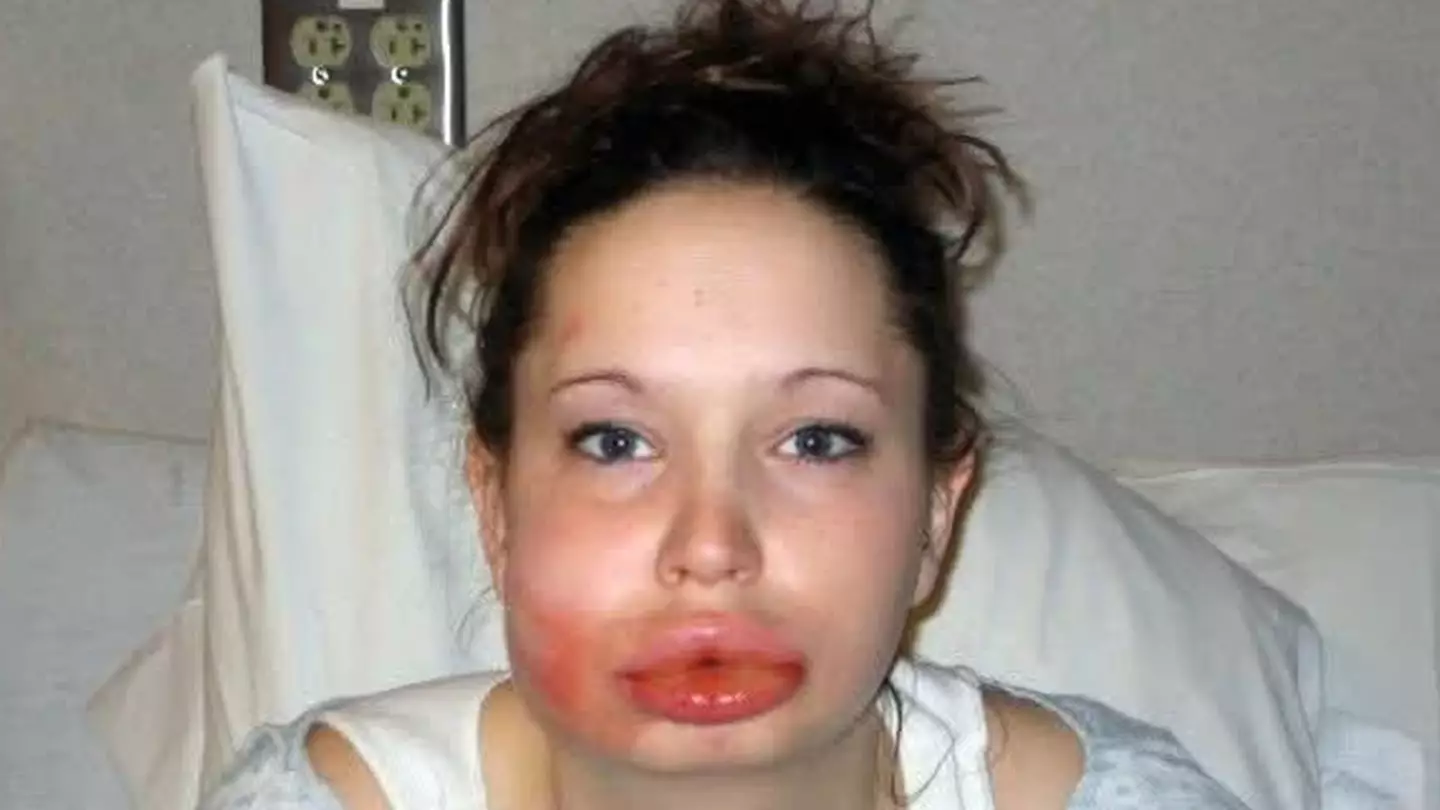 Woman shares horrific photos of burnt face after dangerous 'chroming' trend made her pass out