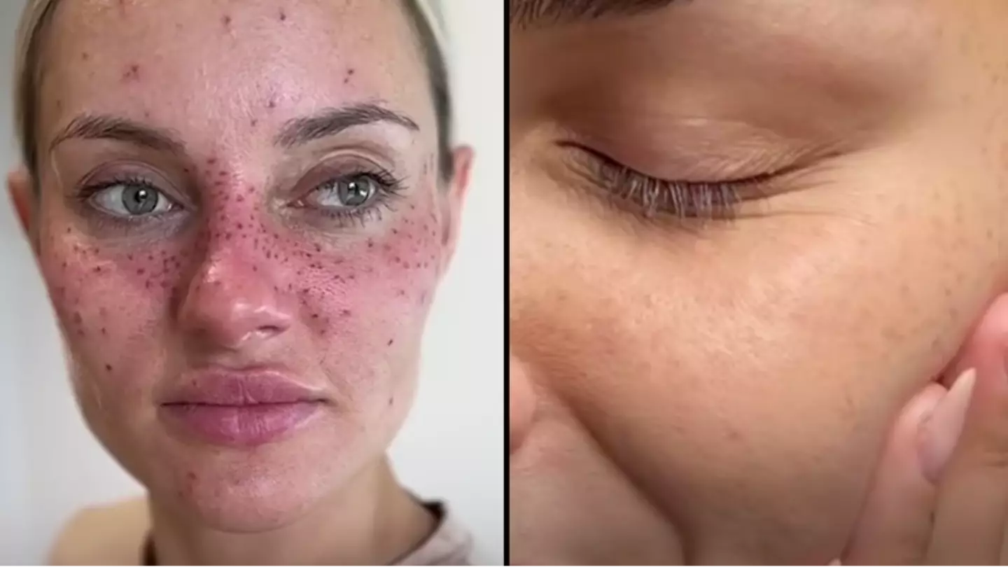 People are getting freckles tattooed onto their face in the latest fashion trend