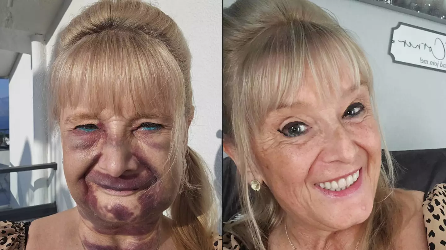 Gran left with bruised face after having gnashers removed and replaced with £8,000 'Turkey teeth'