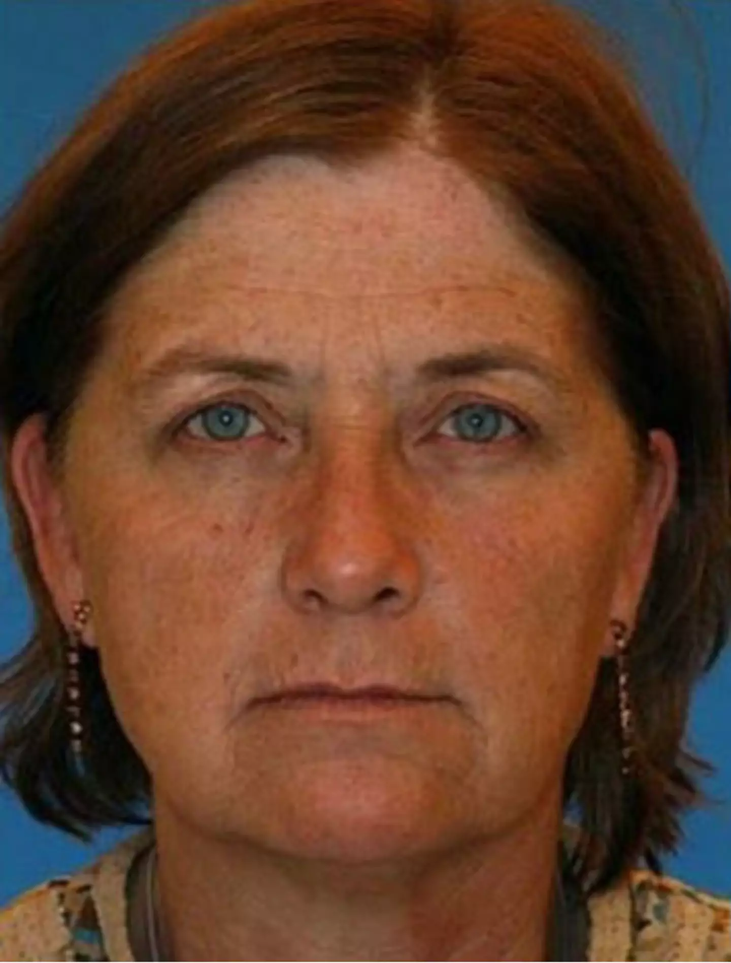 And this is the identical twin who did smoke (American Society of Plastic Surgeons / Dr. Bahman Guyuron)