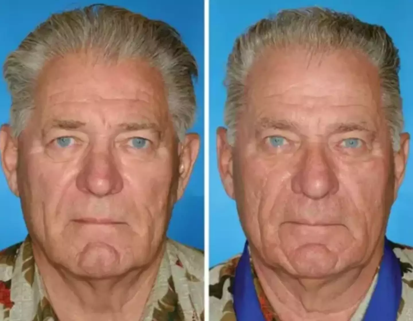 Both men here were smokers, however the right-hand twin smoked for 14 years longer. (American Society of Plastic Surgeons)