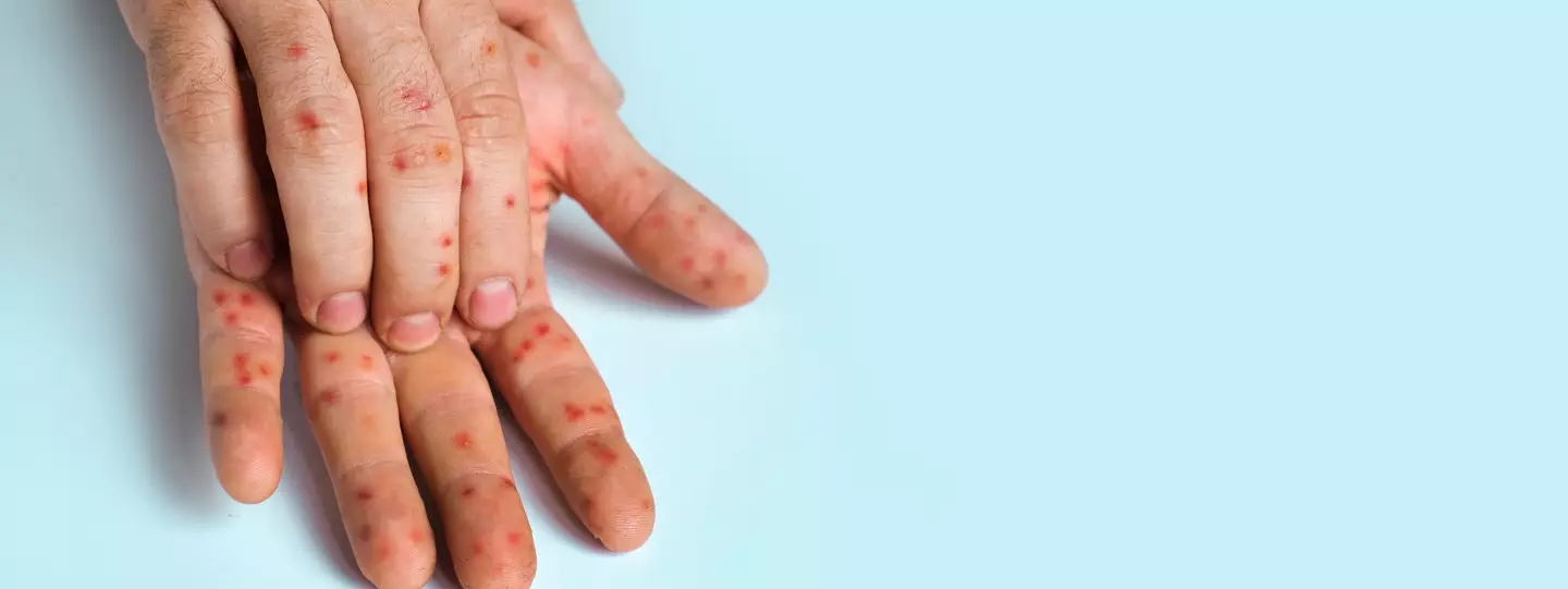 It's worth keeping an eye out for the rash. (Getty Stock Photo)