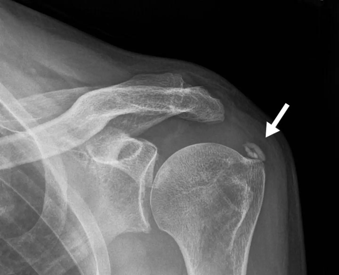 Calcium deposits on the shoulder (Cleveland Clinic)