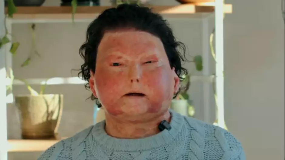 Man who had first ever successful face and double hand transplant shares ‘graphic’ details he can’t put online