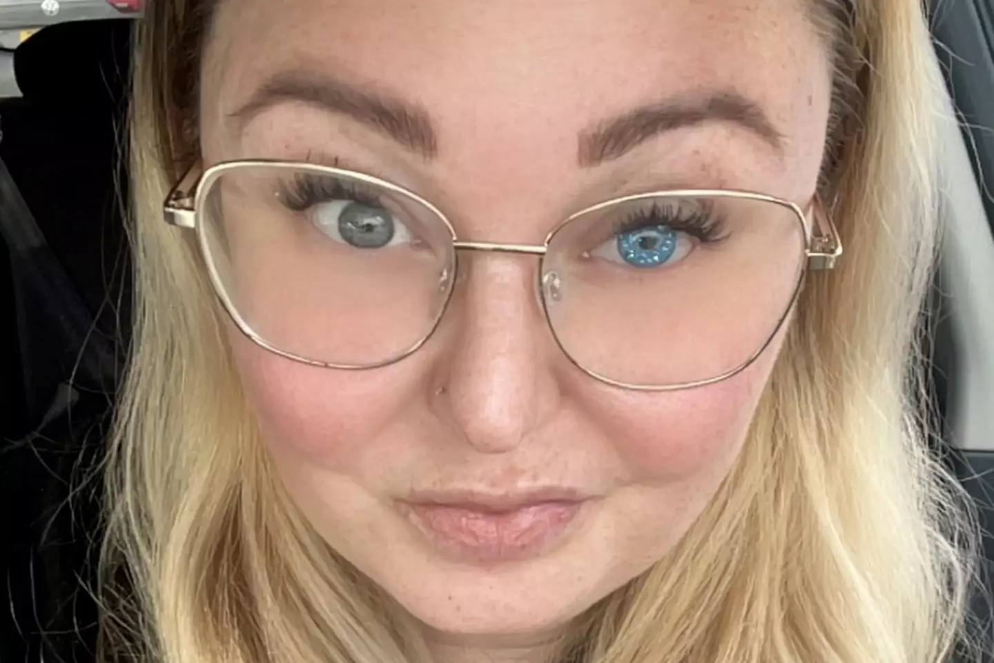 She's now got a glittery prosthetic eye, and says her daughter loves it (SWNS)