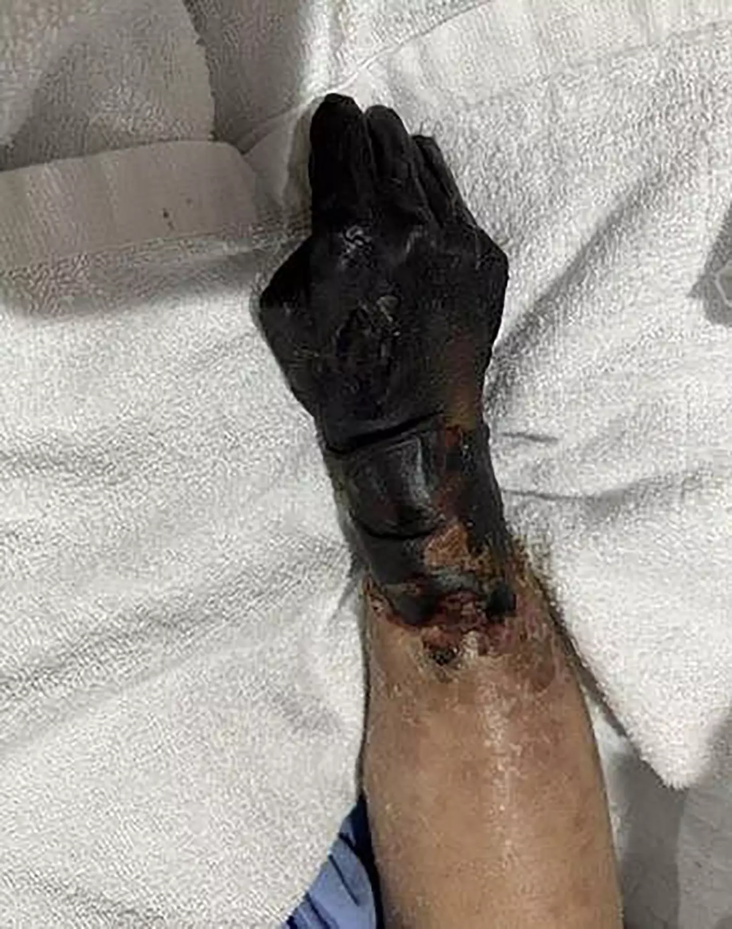 Ling's hands and feet turned black. (Newsflash)