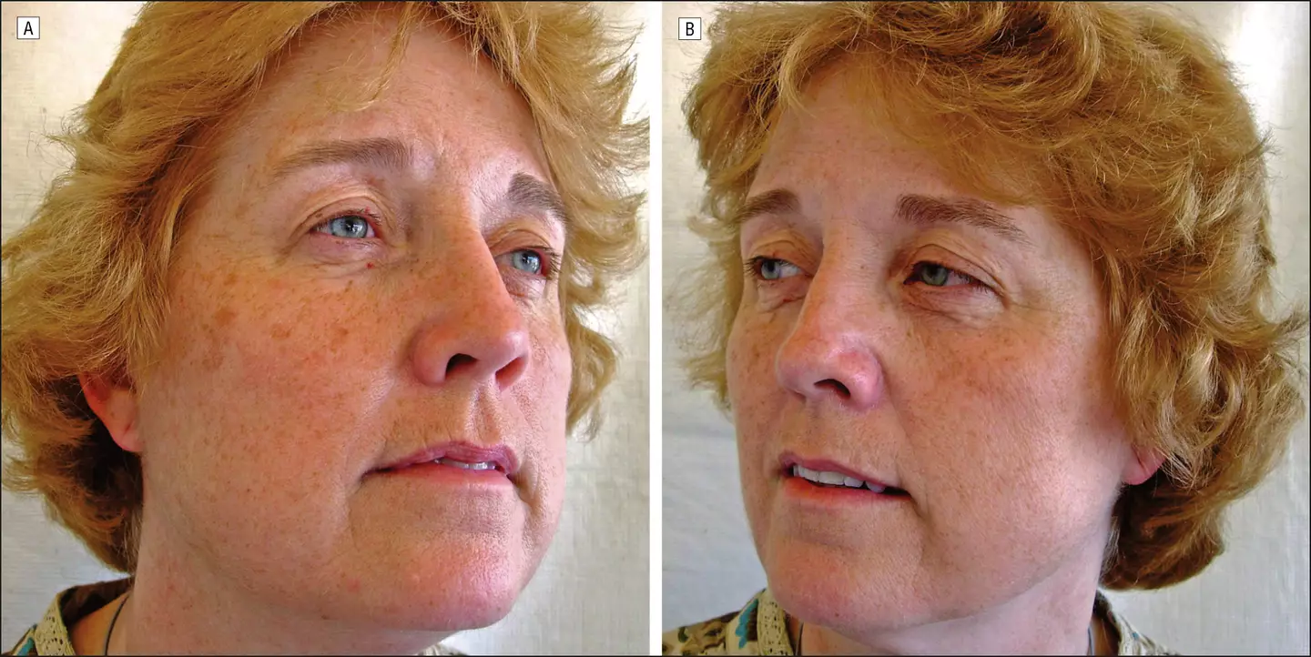 The non-smoker had a better score. (Arch Dermatol/JAMA Dermatology)