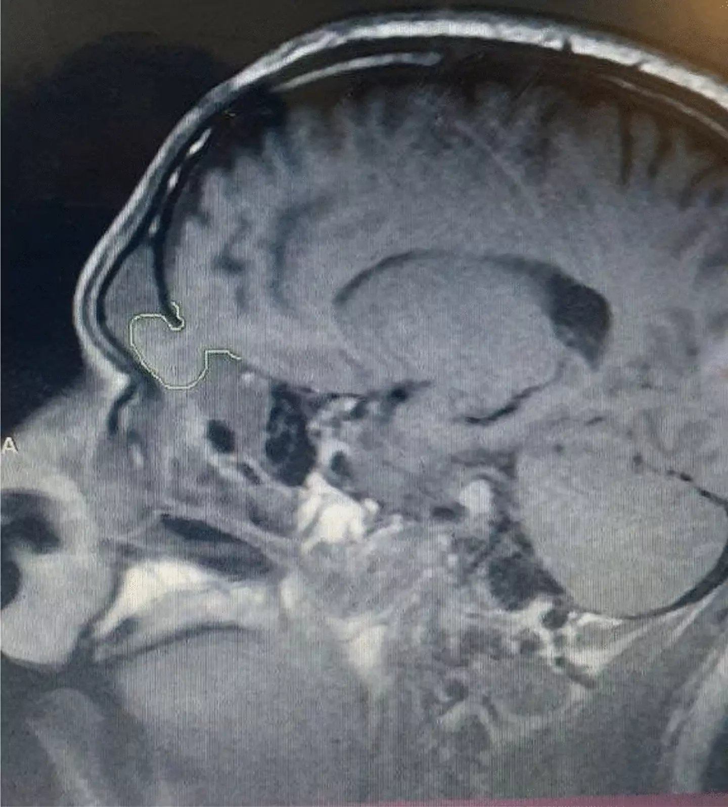 The condition developed after a traumatic head injury (Kenana Tawashi et al)