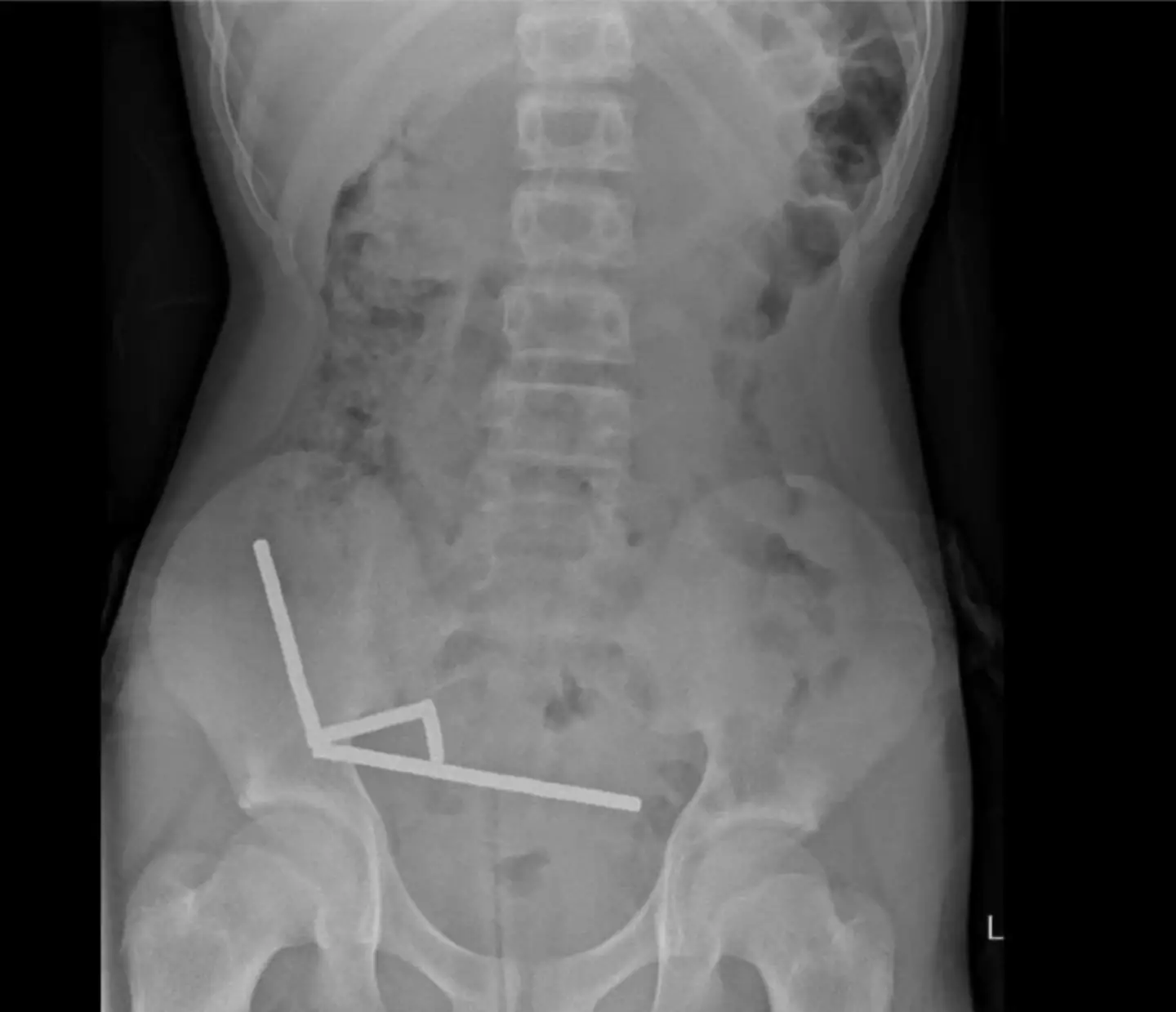 The 13-year-old complained of severe stomach pain before undergoing surgery (New Zealand Medical Journal)