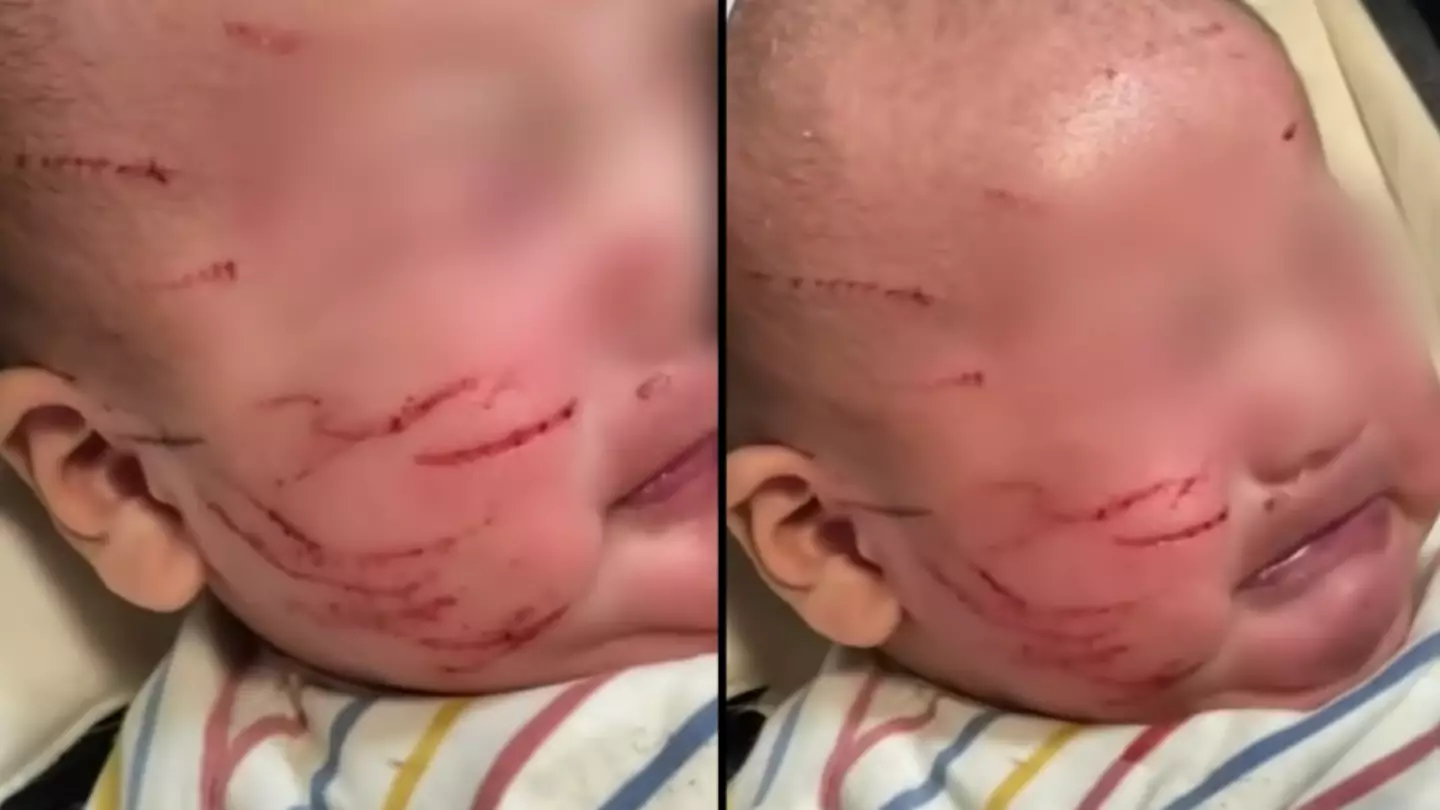 Mum horrified after picking baby up from daycare to find his face scratched all over