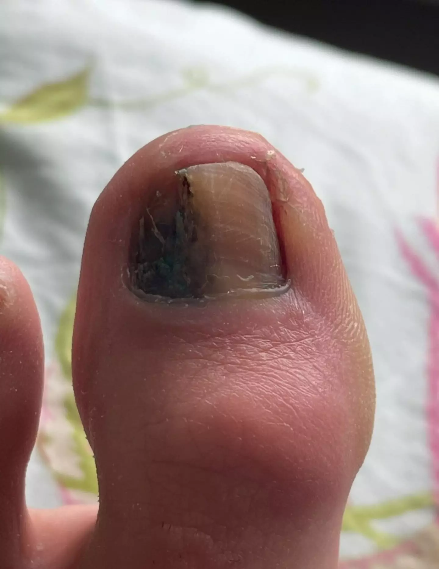 Doctors told her it was a fungal infection at first, and said she should continue the treatment even after tests showed it wasn't (Cover Images)