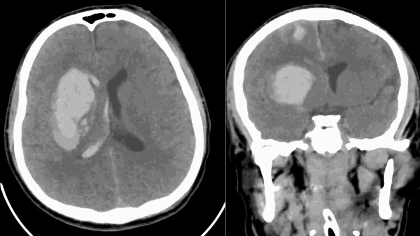 Doctors issue fresh warning over killer fungal infection posing a 'serious threat to humanity'