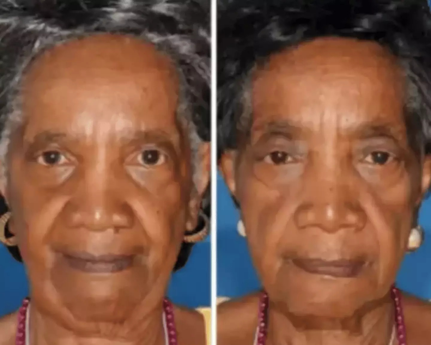 The twin on the left here is a non-smoker (American Society of Plastic Surgeons)