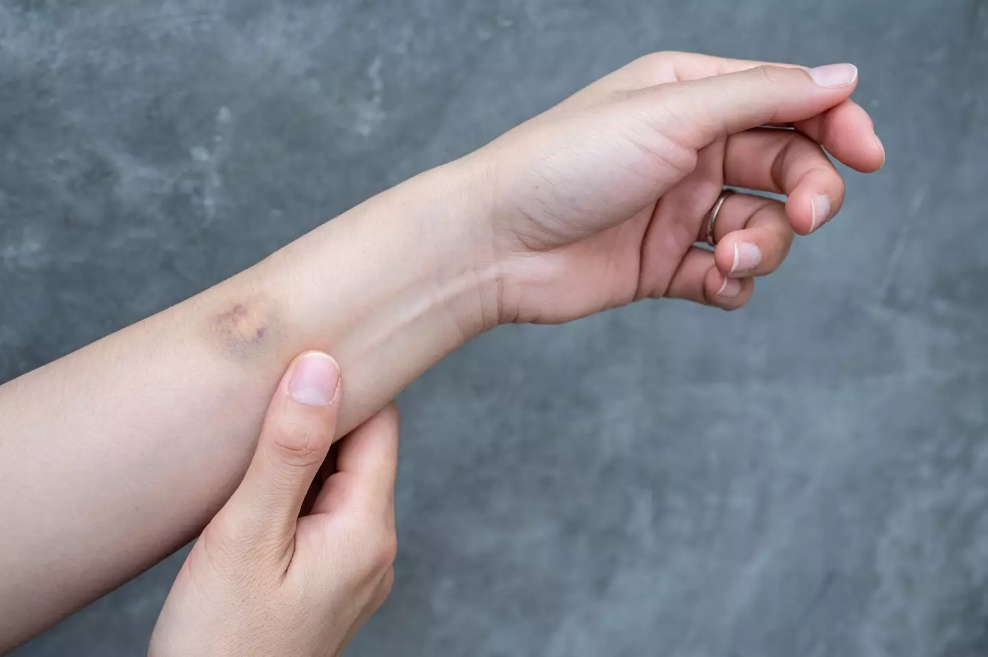 Recurring bruises can signal something more serious. (Getty Stock Photo)