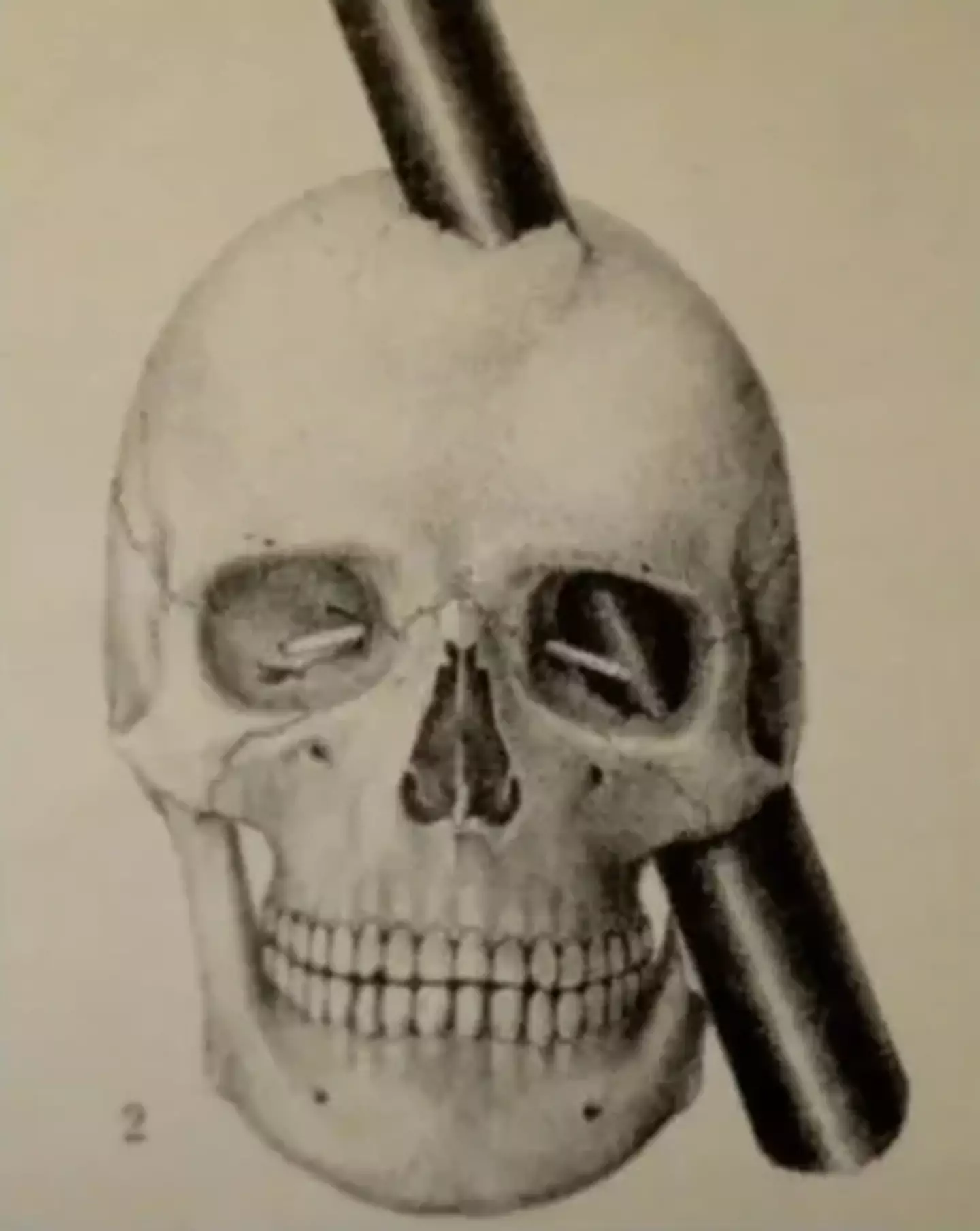 Gage's injury became a huge neuroscience discovery.