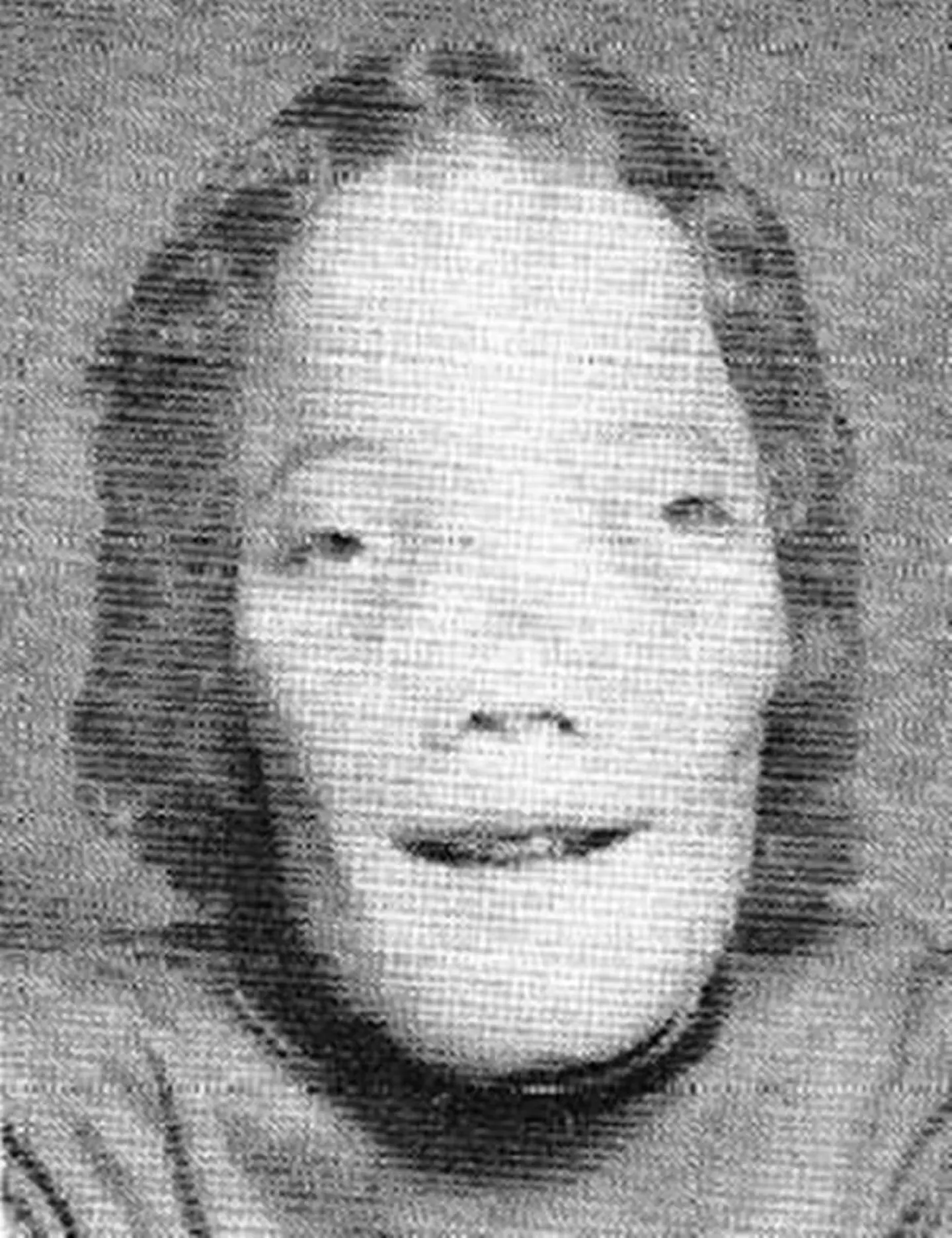 Rocky Dennis was diagnosed with craniodiaphyseal dysplasia when he was two.